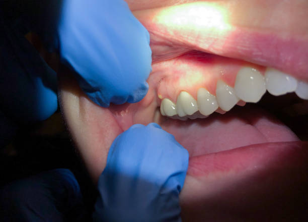 Best Emergency Dentist for Knocked-Out Tooth in Lenox, IA